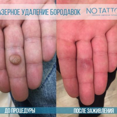 udalenie-borodavky